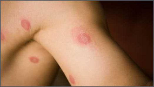 Pilze in Zimmerpflanzen Ursachen Symptome und Behandlung